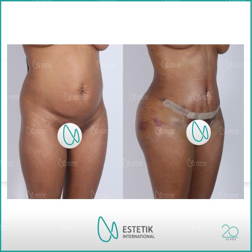 Before after photos of our patients 0
